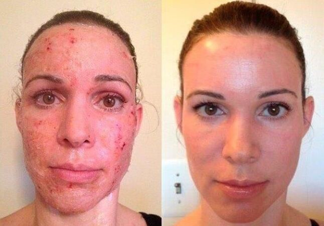 fractional skin rejuvenation before and after photo 1