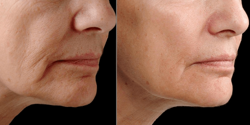 Laser fractionated renewal - effect
