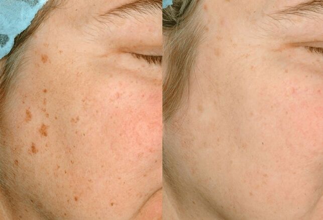 To remove pigmentation on the skin