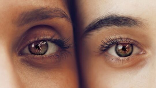 Dark circles under the eyes